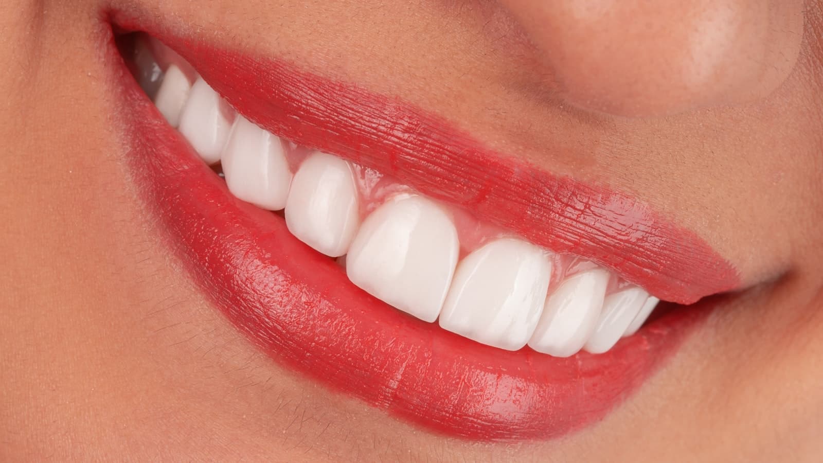 Veneers in Turkey: The Complete 2026 Guide (Costs, Types & How to Avoid 'Turkey Teeth')